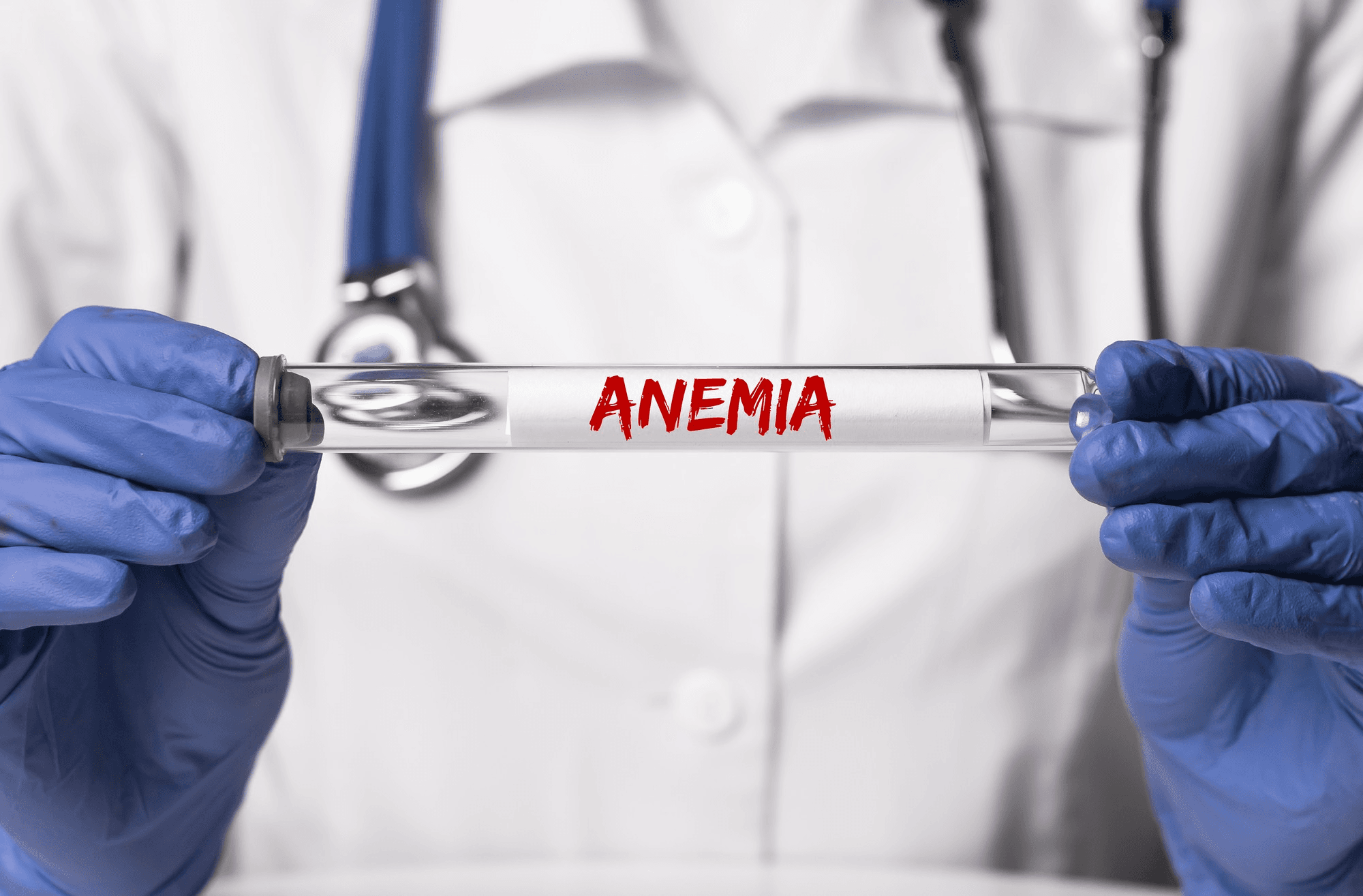 A doctor wearing gloves holding a test tube labeled anemia, symbolizing blood testing, diagnosis, medical examination, and healthcare awareness.