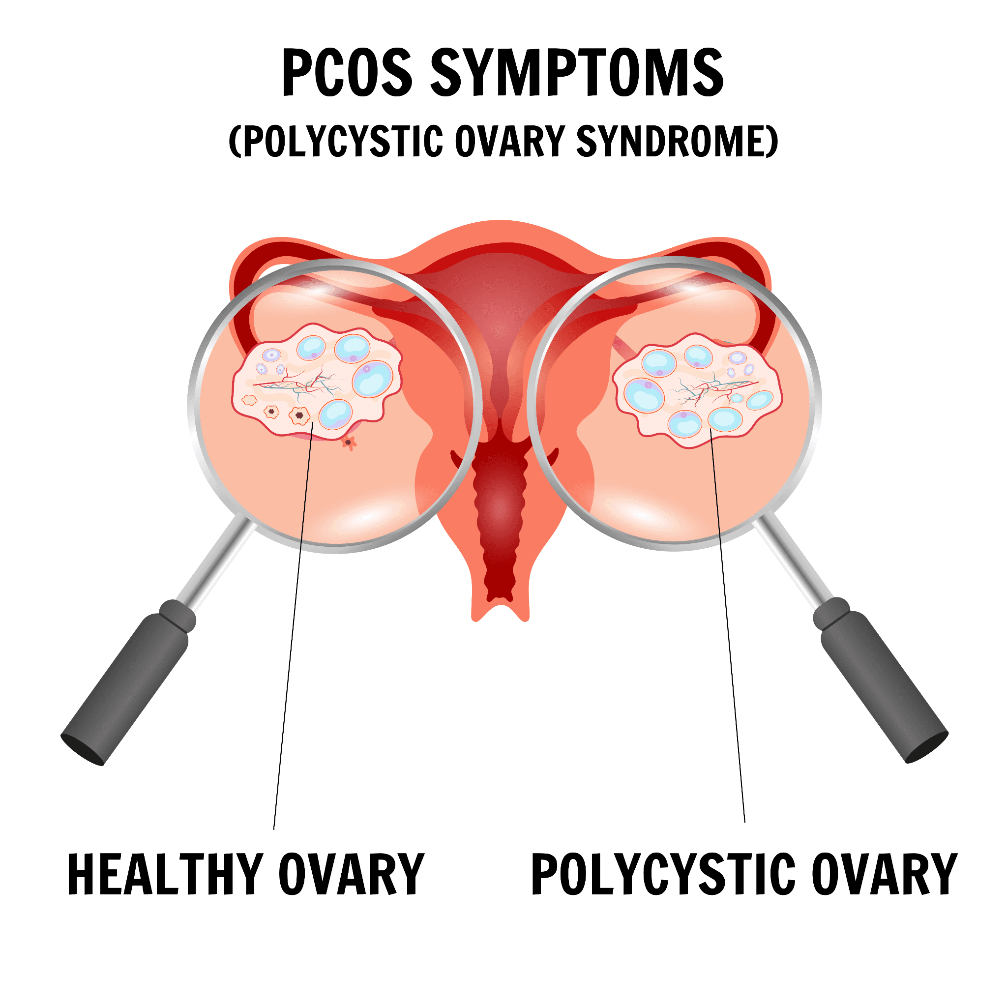 Pictorial infographic of the difference between a healthy ovary and a polycystic ovary.