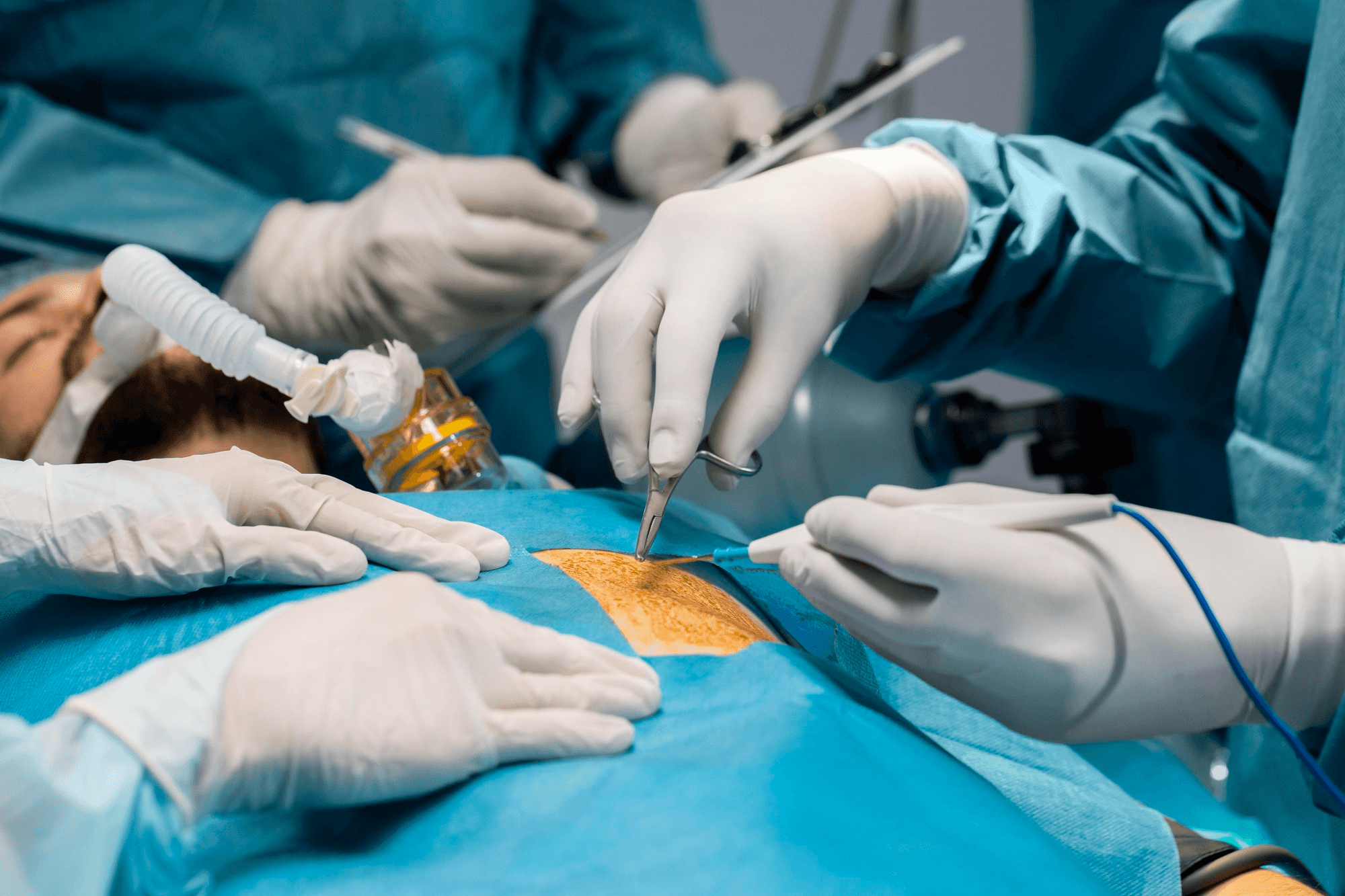 A small cut, made during a minimally invasive procedure, is shown with the instruments involved, depicting precision.