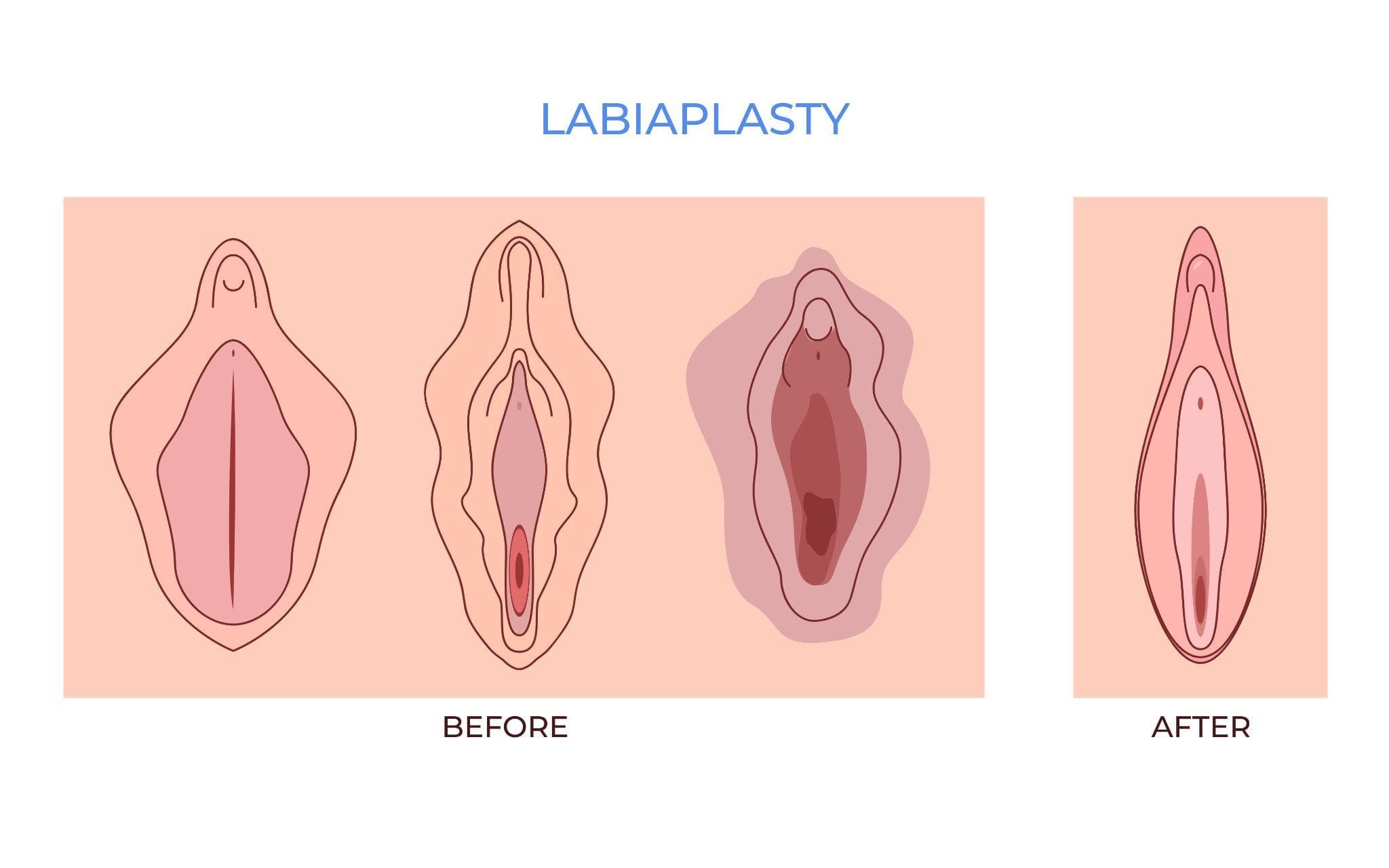 ** A medical illustration titled Labiaplasty, showing anatomical diagrams of the female external genital area, comparing different labia shapes in a before-and-after surgical representation on a pink background.