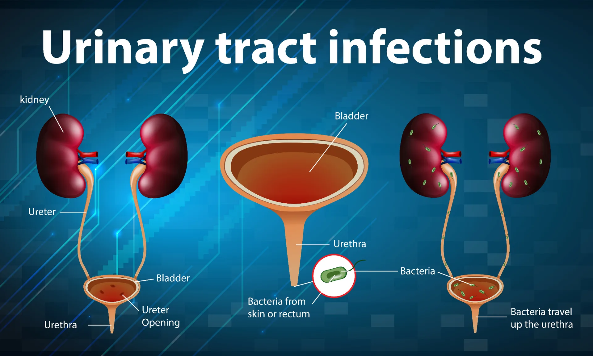 Medical infographic illustrating a urinary tract infection (UTI), showing the urinary bladder and the location where bacteria enter and multiply.